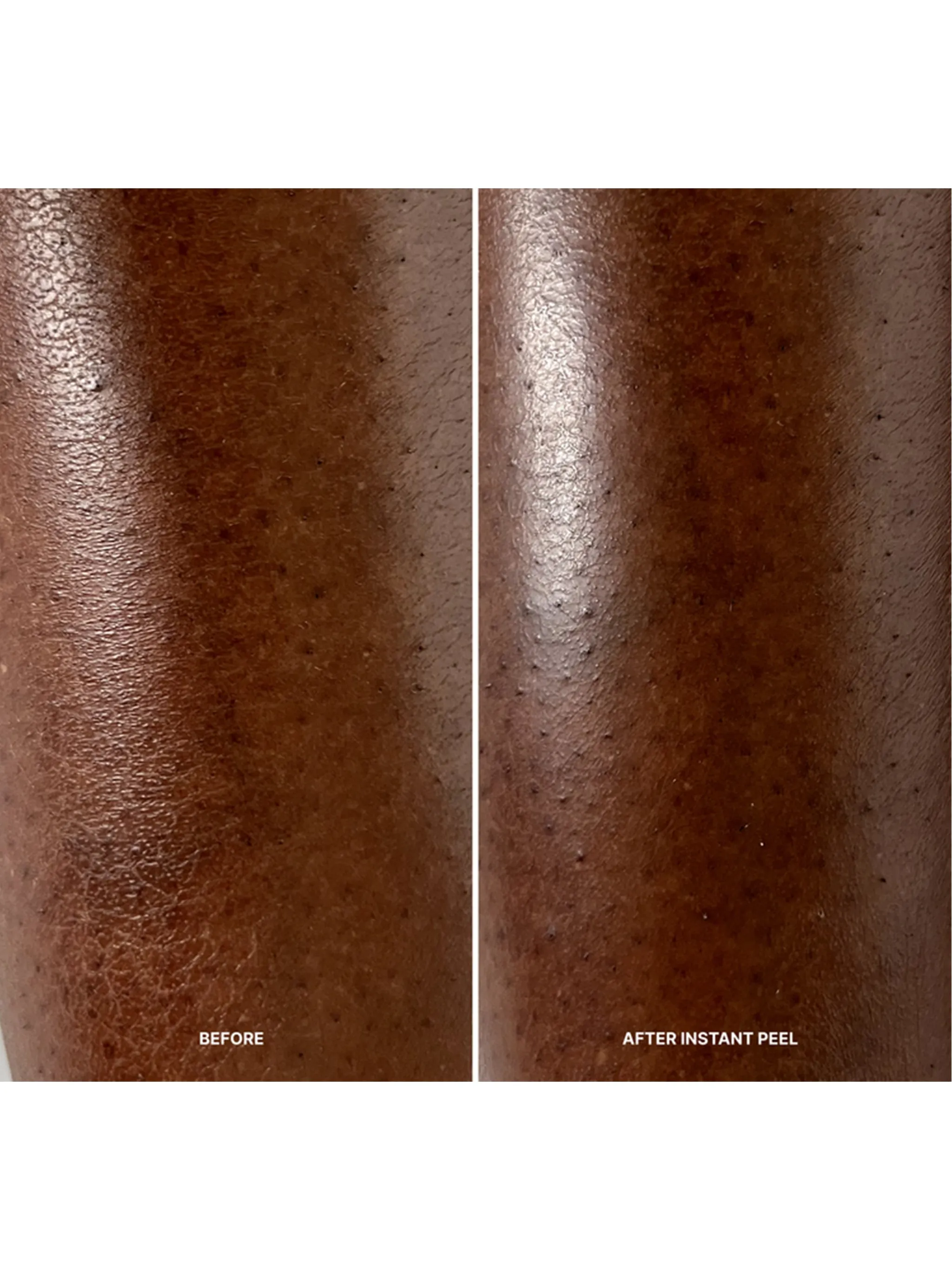 Korean Body Resurfacing™ Set