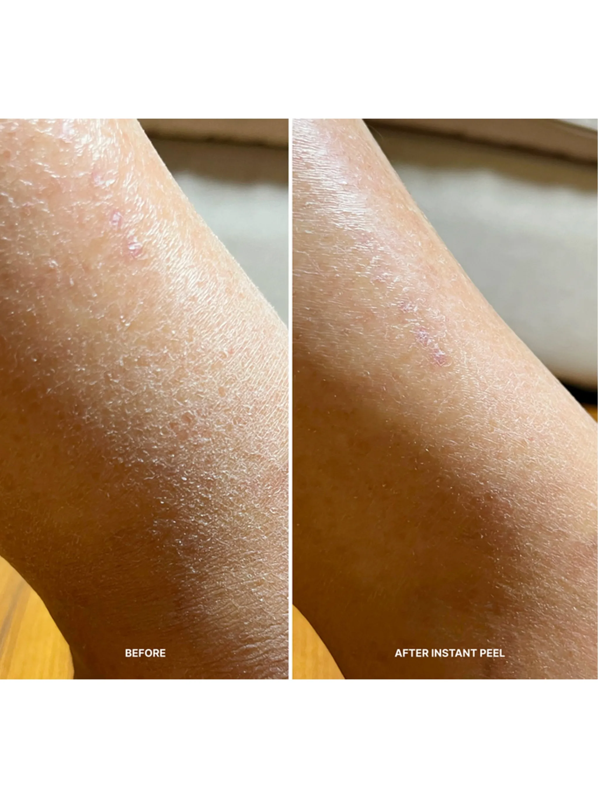 Korean Body Resurfacing™ Set
