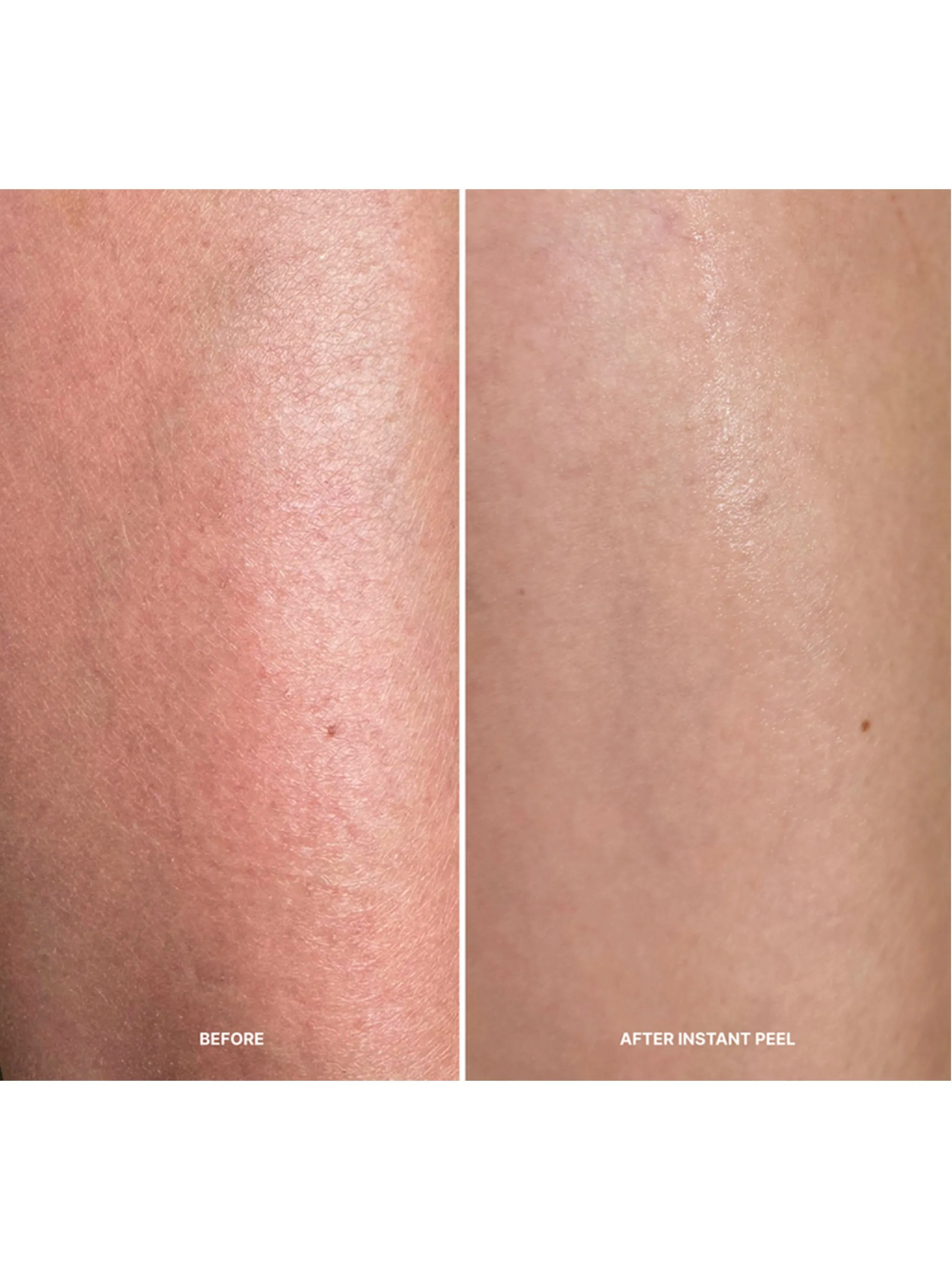 Korean Body Resurfacing™ Set